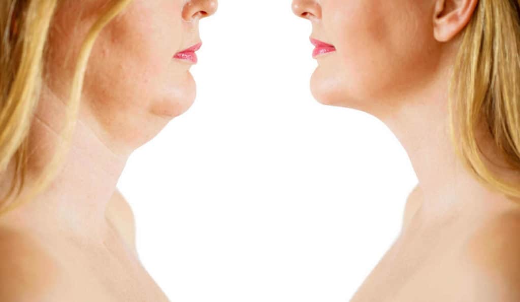 Double Chin treatment Greater London (City of London) before and after results
