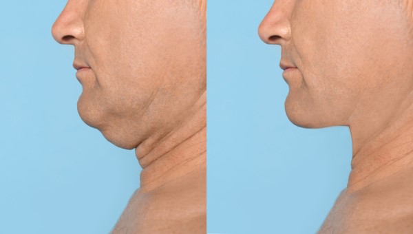 Which Non-Surgical Treatments Work Best for Jowls and Loose Skin Greater London (City of London)?