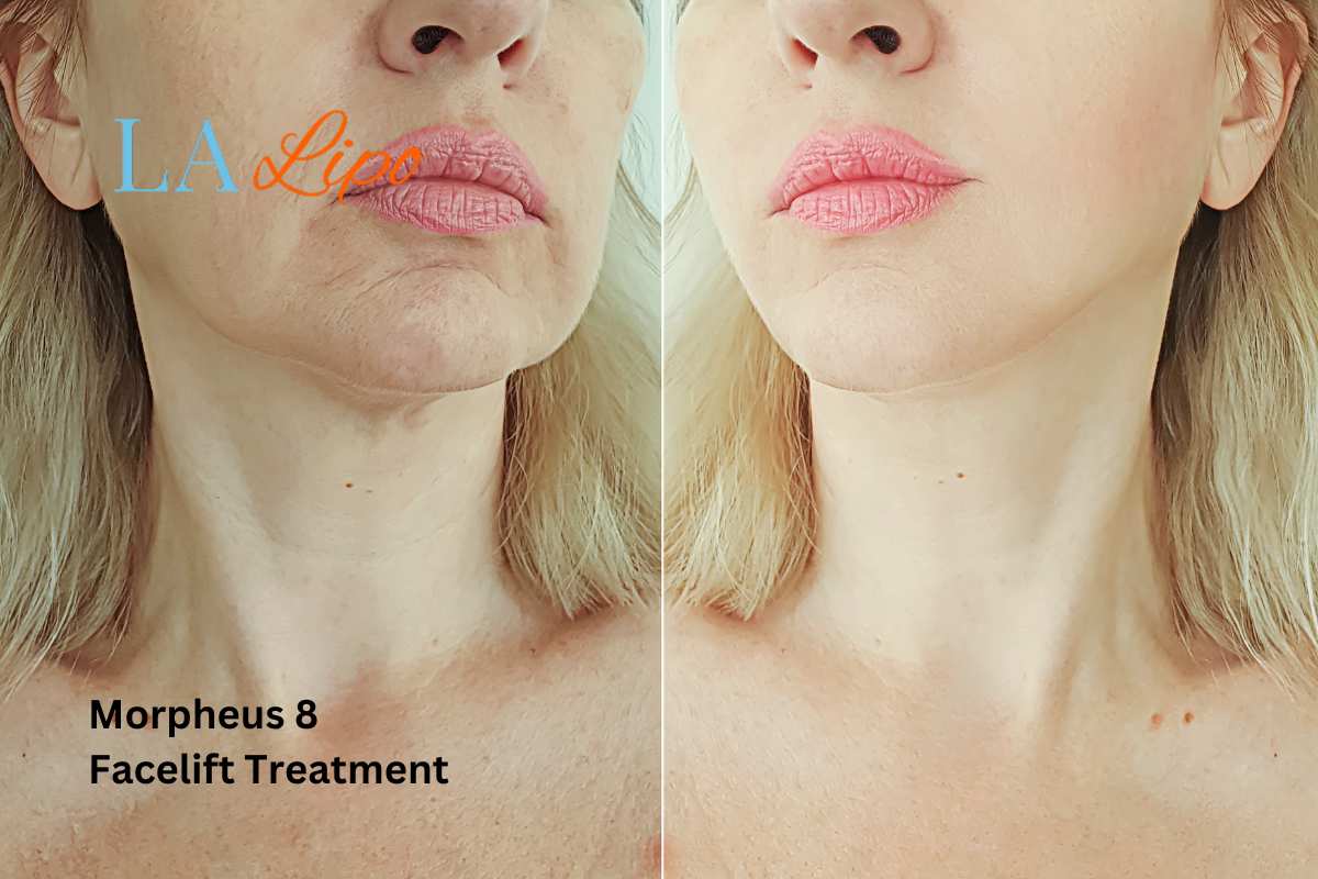 Turn back time with Morpheus8 Treatment Greater London (City of London)