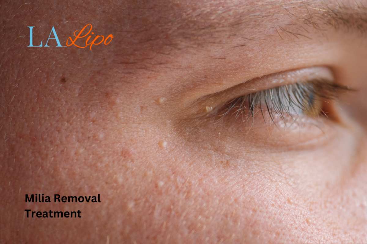 Cryopen Milia Removal: Is It the Easiest and Safest Option Greater London (City of London)?