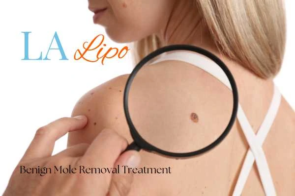 Woman having her inspection of blemish before mole removal Greater London (City of London)