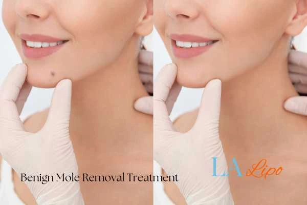 Before and after mole removal Greater London (City of London) treatment
