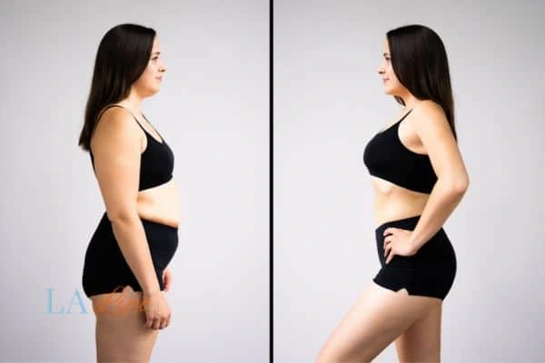 LA-EMS Body Sculpting Greater London (City of London) results before and after of womans results on body toning.