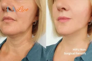 hi-fu for wrinkles Greater London (City of London) before and after results