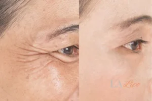 Before and after results of woman - HI-fu wrinkles reduction treatment Greater London (City of London)