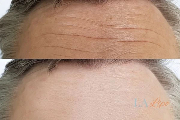 results of HIFU Greater London (City of London) on mans forehead to help reduce lines and wrinkles