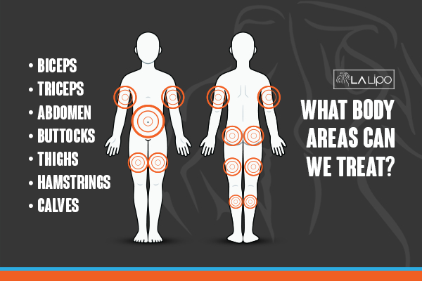 Graphic to show areas you can have LA-EMS Body Sculpting Greater London (City of London) treatment.