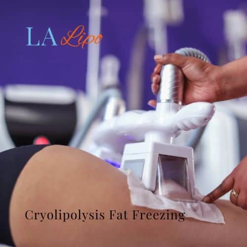 fat freezing - Cryolipolysis Greater London (City of London)