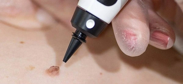 skin tag removal using cryopen Greater London (City of London)
