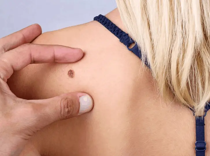 woman having mole removal Greater London (City of London) consultation before treatment.
