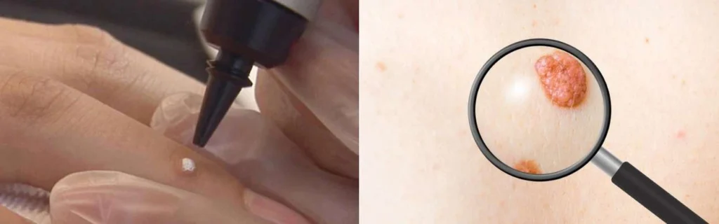 Person getting moles removed with cryopen Greater London (City of London)