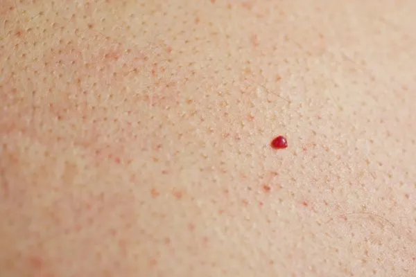 close up of a cherry angioma Greater London (City of London)