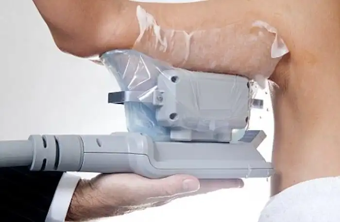 Picture of fat freezing Greater London (City of London) on the upper arms.