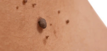 image of a skin tag Greater London (City of London)