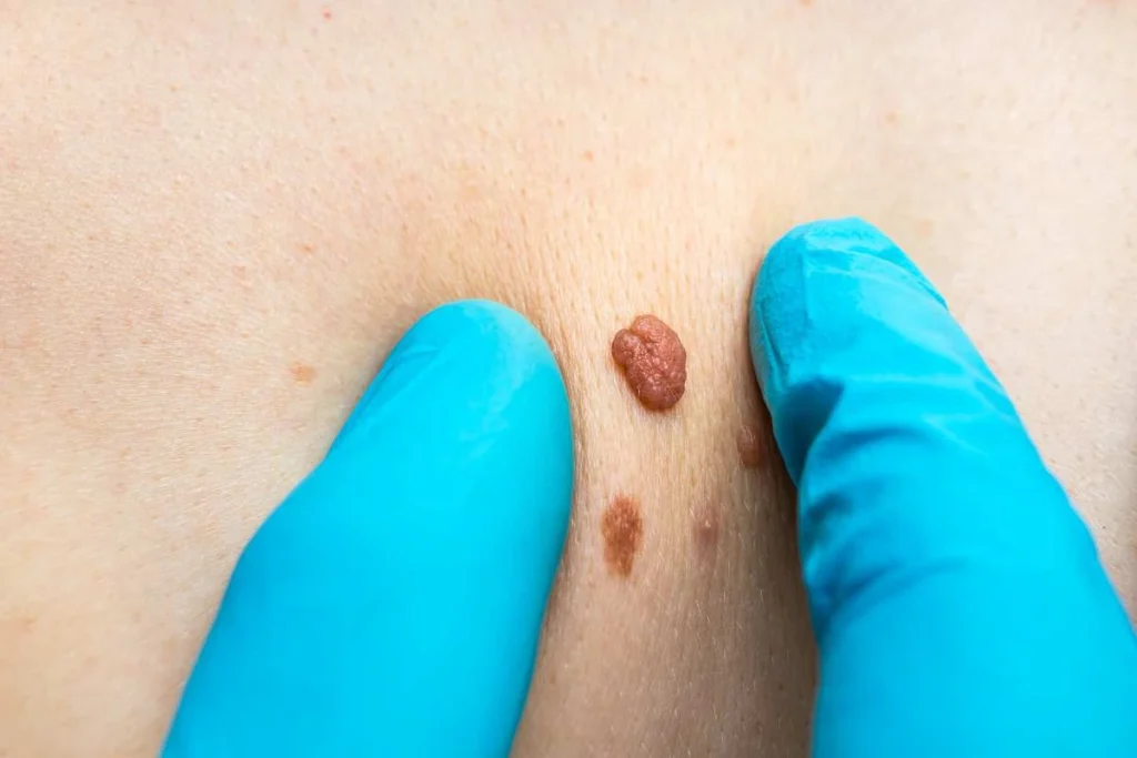 Consultant examining a skin tag Greater London (City of London)