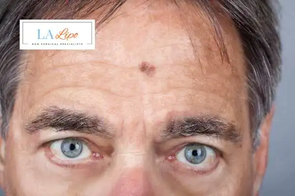 Solar Lentigo Removal Greater London (City of London) image of man with mark on his forehead