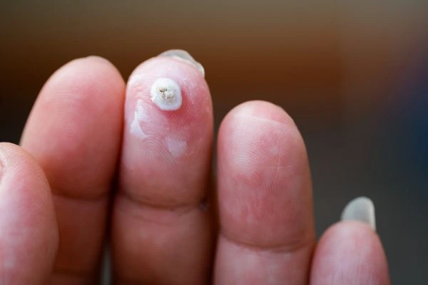 wart on person finger - cryotherapy to treat from LA LIPO Greater London (City of London)