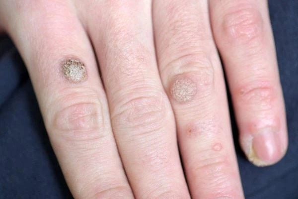 photo of warts on person hand - see wart removal Greater London (City of London) from LA LIPO
