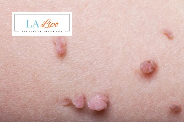 Does cryopen skin tag removal Greater London (City of London) hurt? Find out now call our team today!