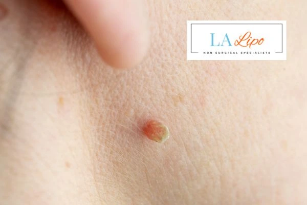 Book skin tag removal Greater London (City of London) today speak to our team now!