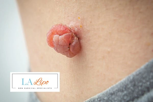 Interested in skin tag removal Greater London (City of London)? Concerned about the pain? Find out more today!