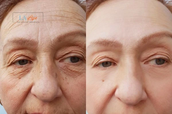 The powerful benefits of Morpheus8 Treatment Greater London (City of London) - Call Our team today!
