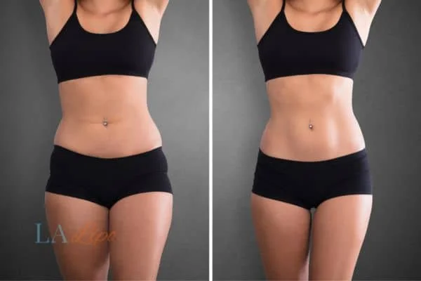 before and after results of non-surgical treatment to help a woman's body image and mental health Greater London (City of London)