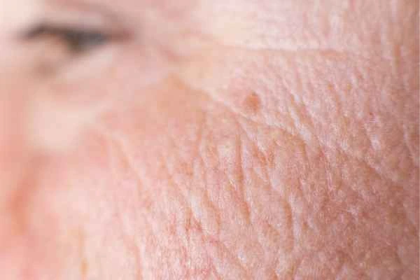 close up picture of a woman's face showing an age spot Greater London (City of London)