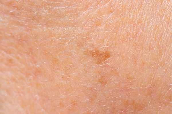 close up picture of age spots Greater London (City of London)