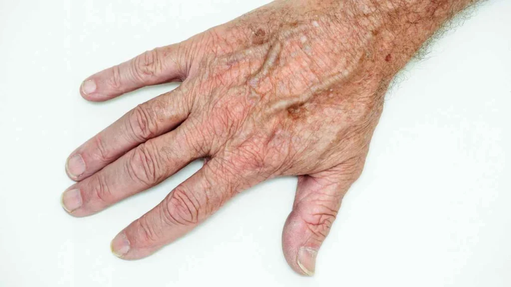 Male hand showing age spot Greater London (City of London)