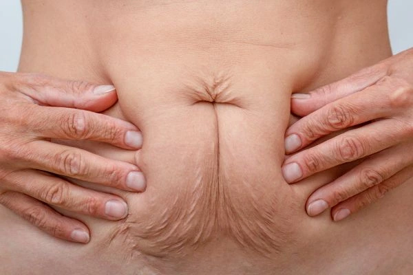 Image of a woman's stomach with loose skin - example of skin tightening Greater London (City of London) options