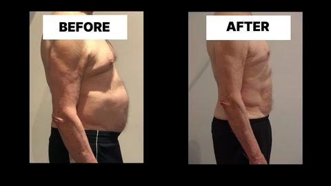 What Symptoms Can Diastasis Recti Cause in Men? Weak Core, Back Pain and Poor Posture Greater London (City of London)